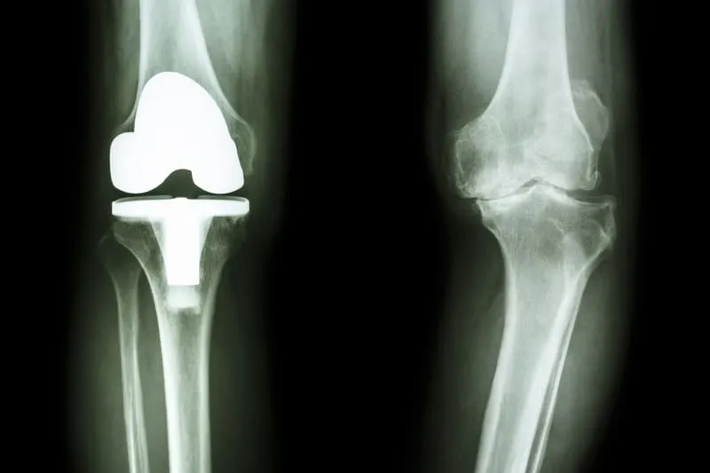 Prótesis de rodilla